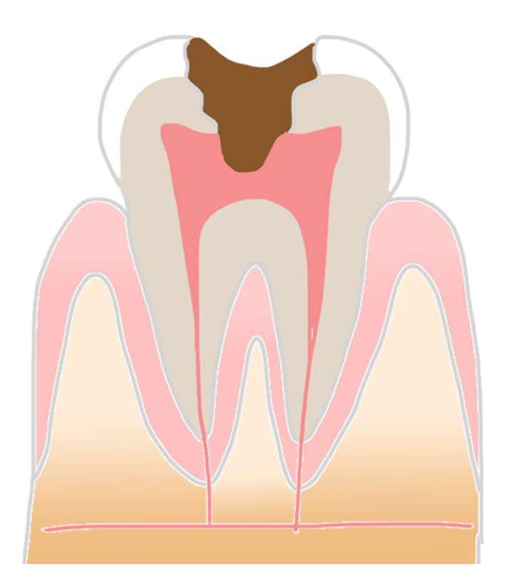 C3虫歯